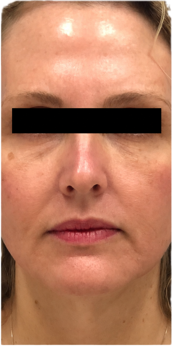 After CO2 laser