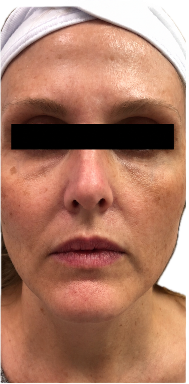 Before CO2 laser
