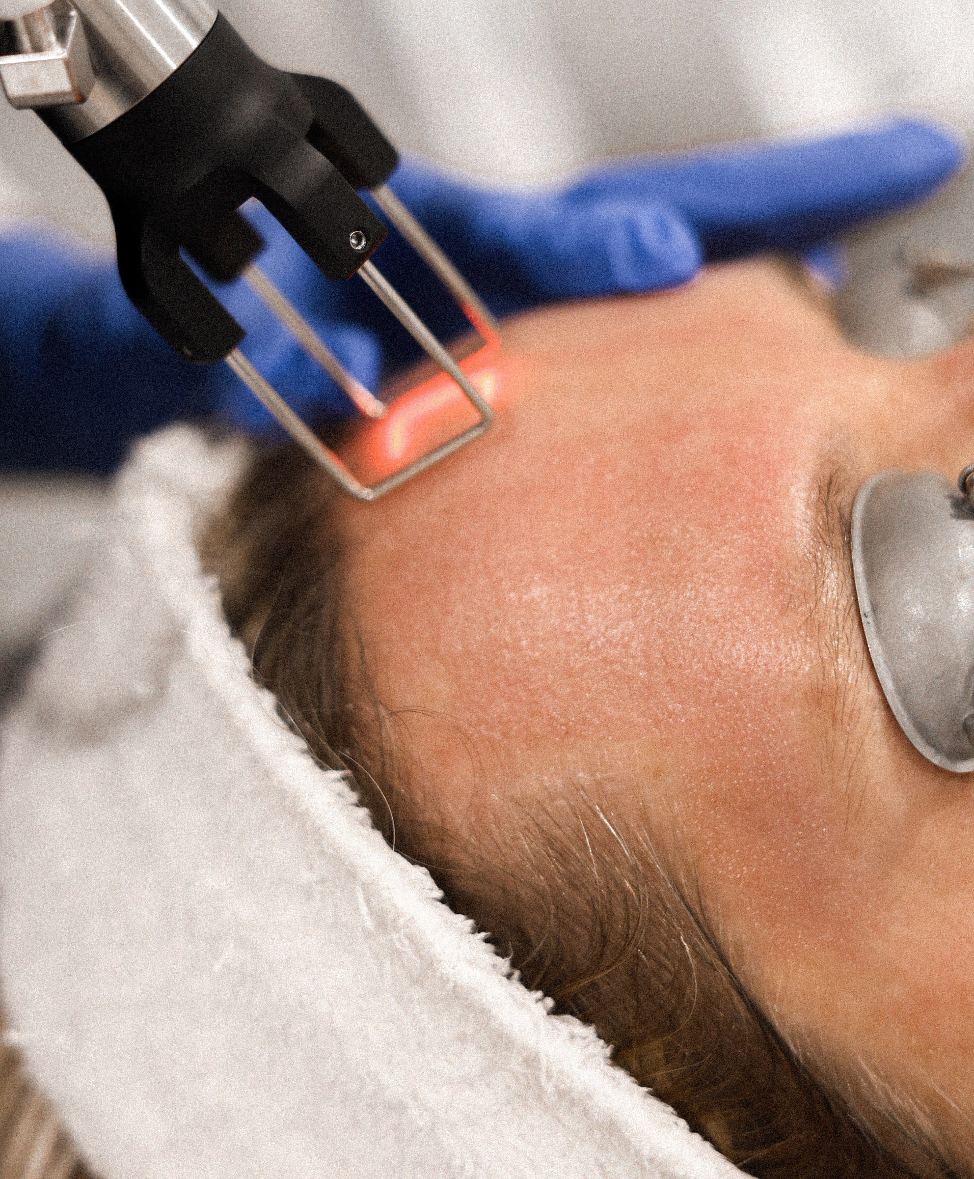 Cool Peel Laser Treatment