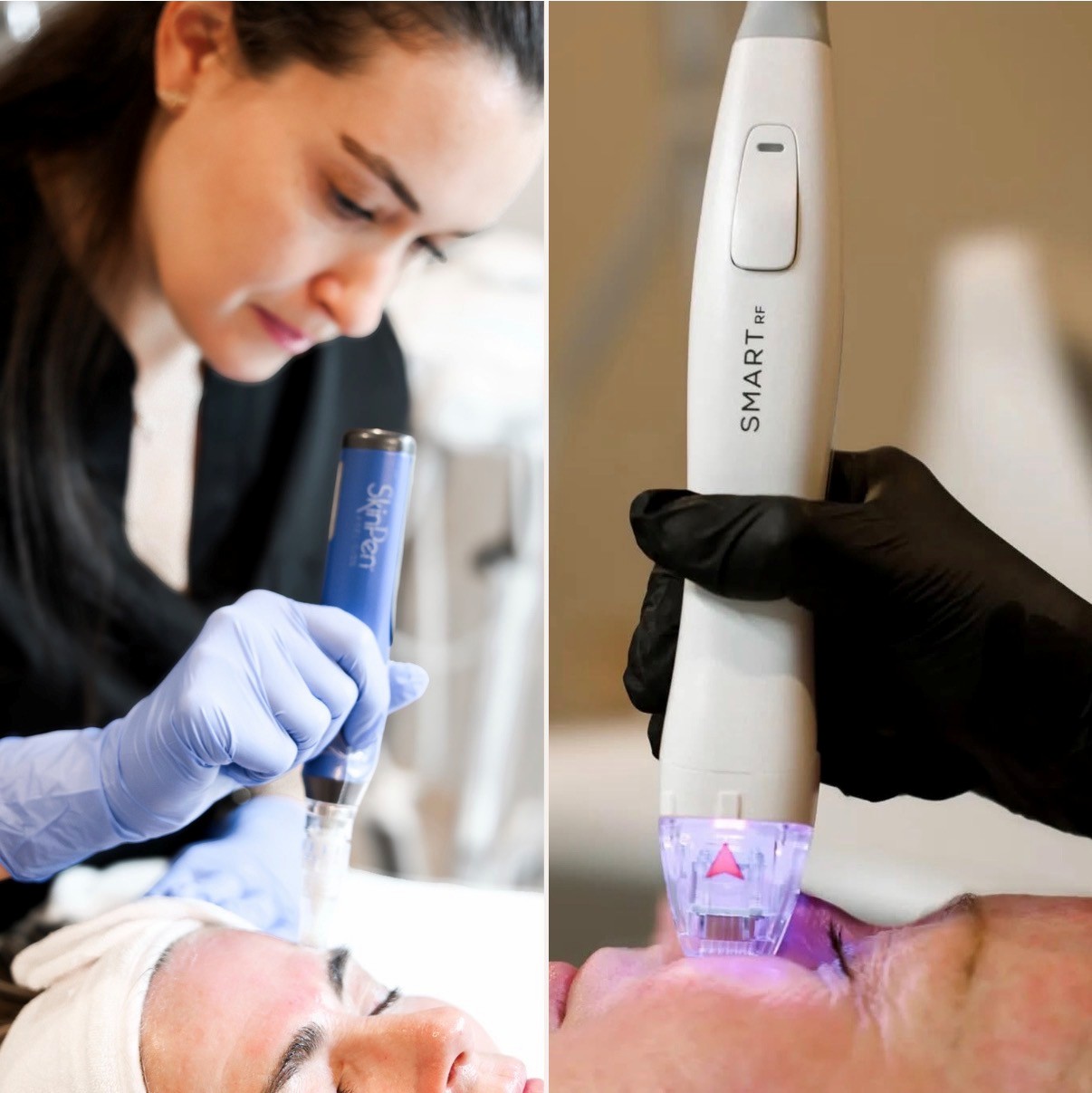 Microneedling skin rejuvenation treatment