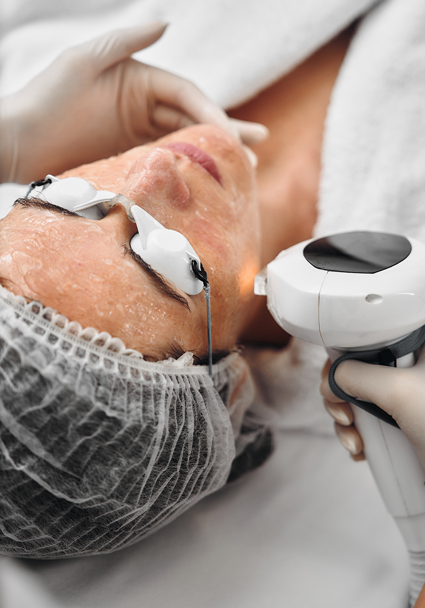 IPL Photofacial Treatments