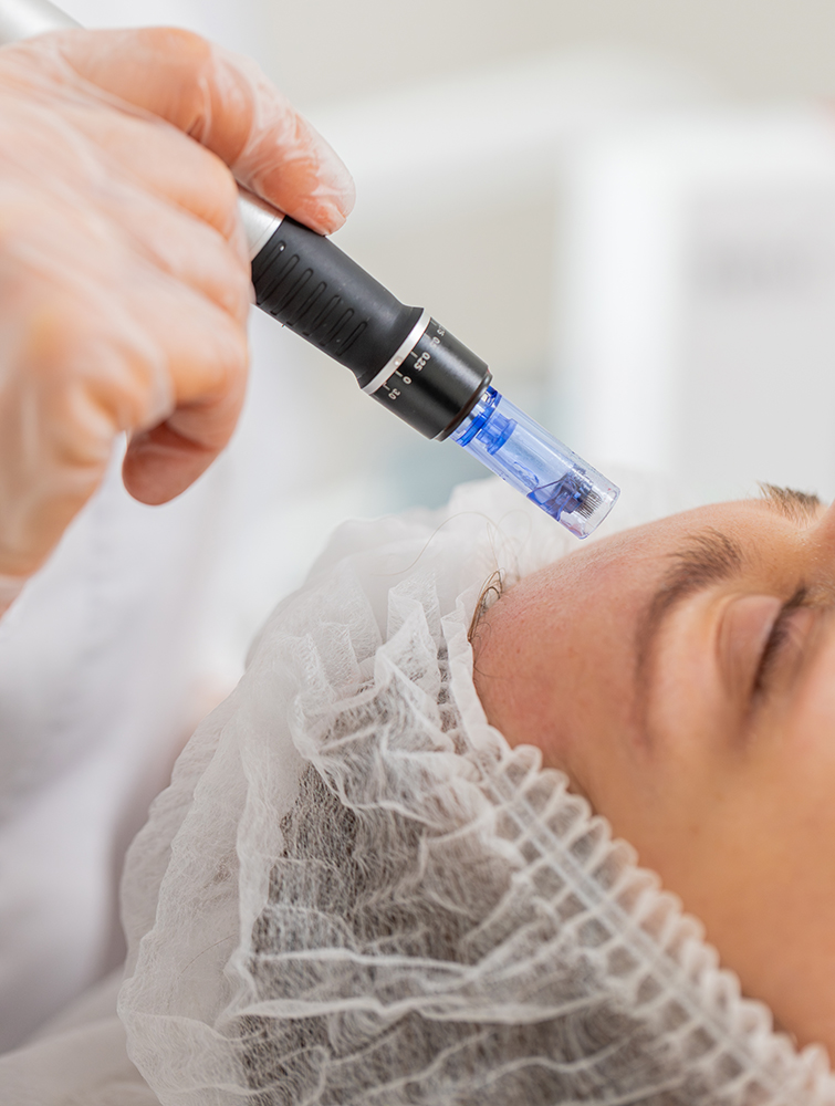 Microneedling skin rejuvenation results