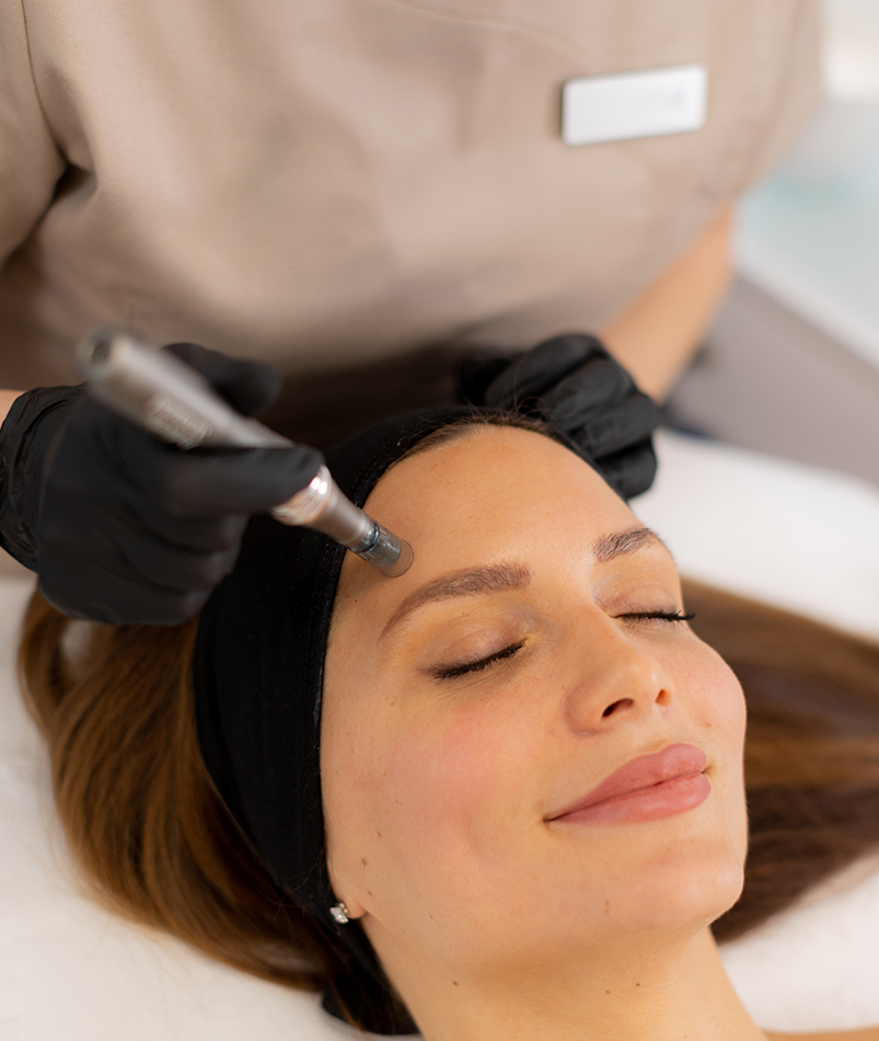 VirtueRF RF microneedling treatment